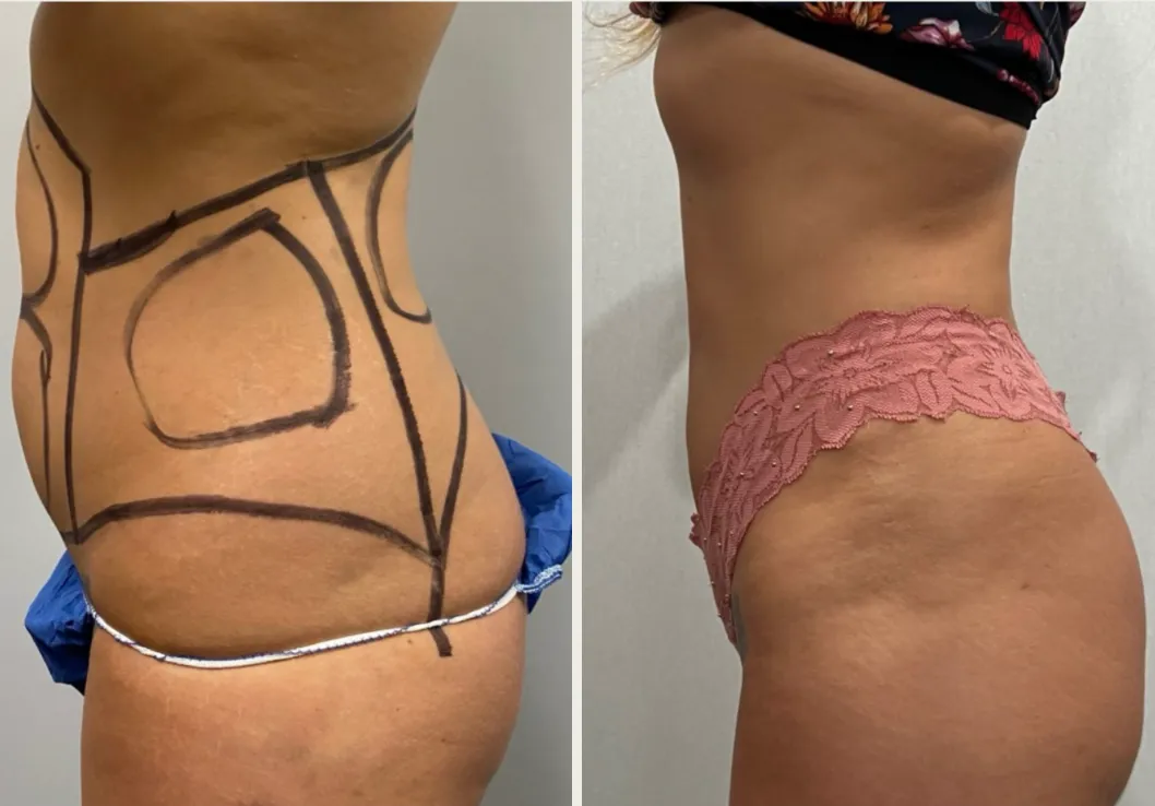 Sides & Flanks before & after — case 84