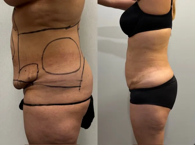 Mini Tummy Tuck before & after — case 56