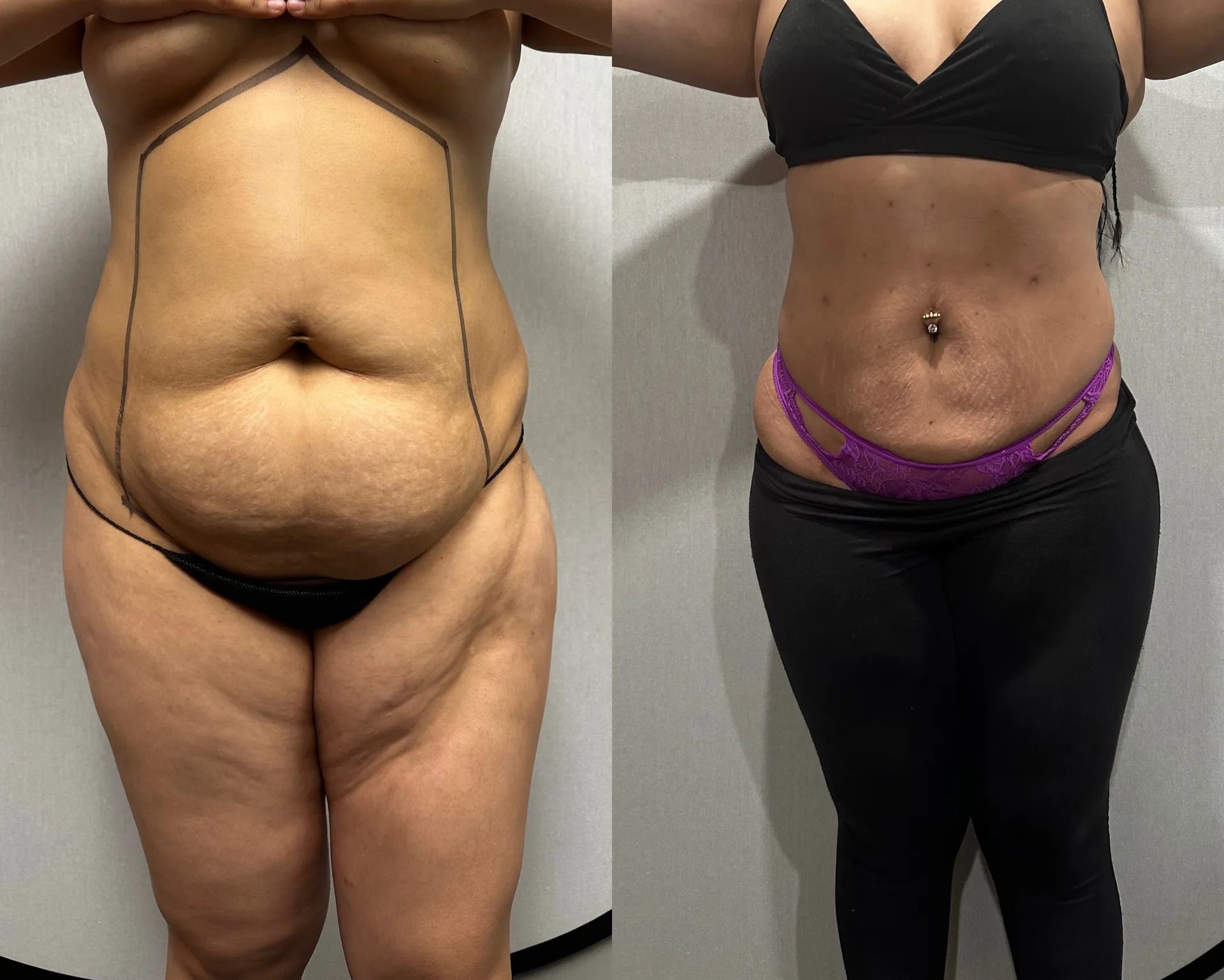 Abdomen before & after — case 25