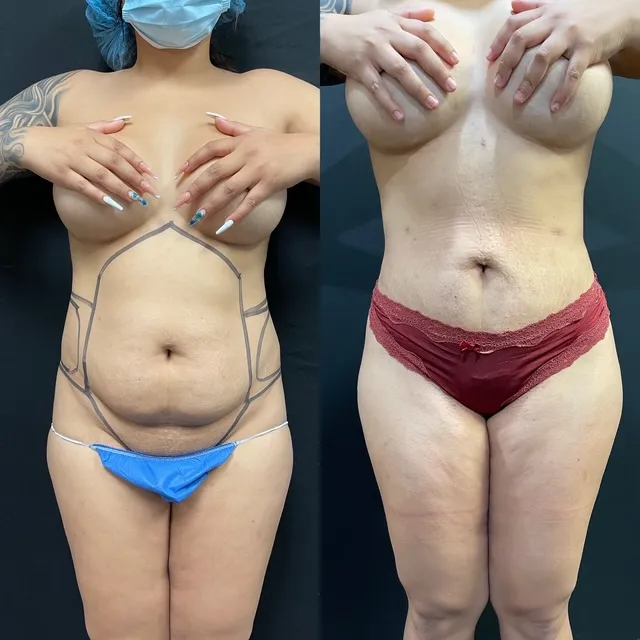 Mini Tummy Tuck before & after — case 59