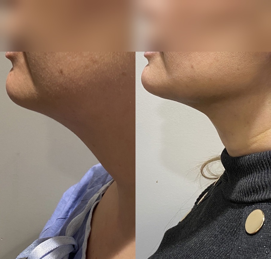Women — Chin & Neck