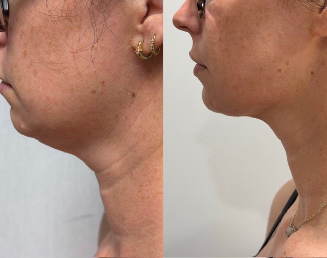 Women — Chin & Neck