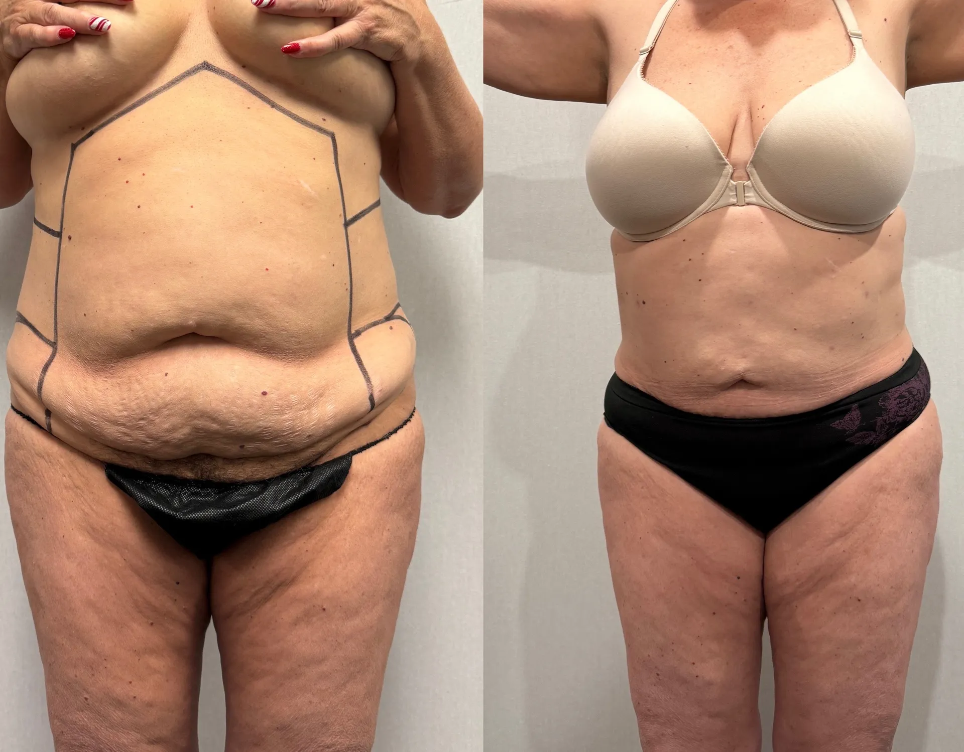 Abdomen before & after — case 27