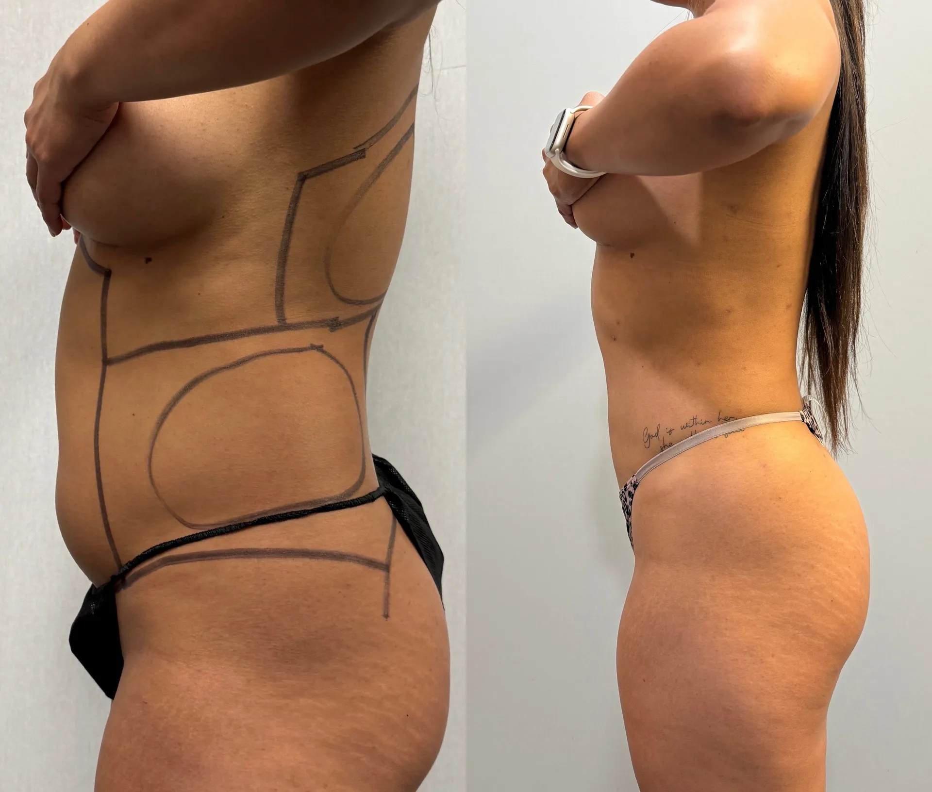 Sides & Flanks before & after — case 79