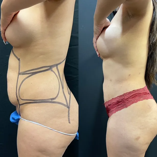 Mini Tummy Tuck before & after — case 60