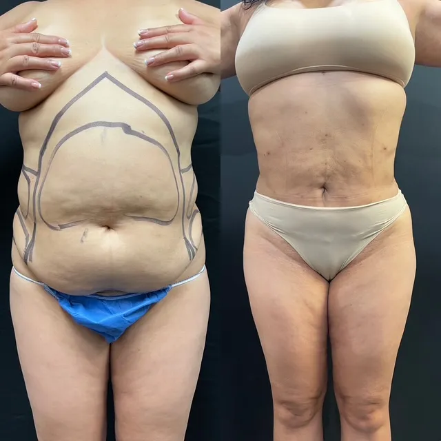 Mini Tummy Tuck before & after — case 61