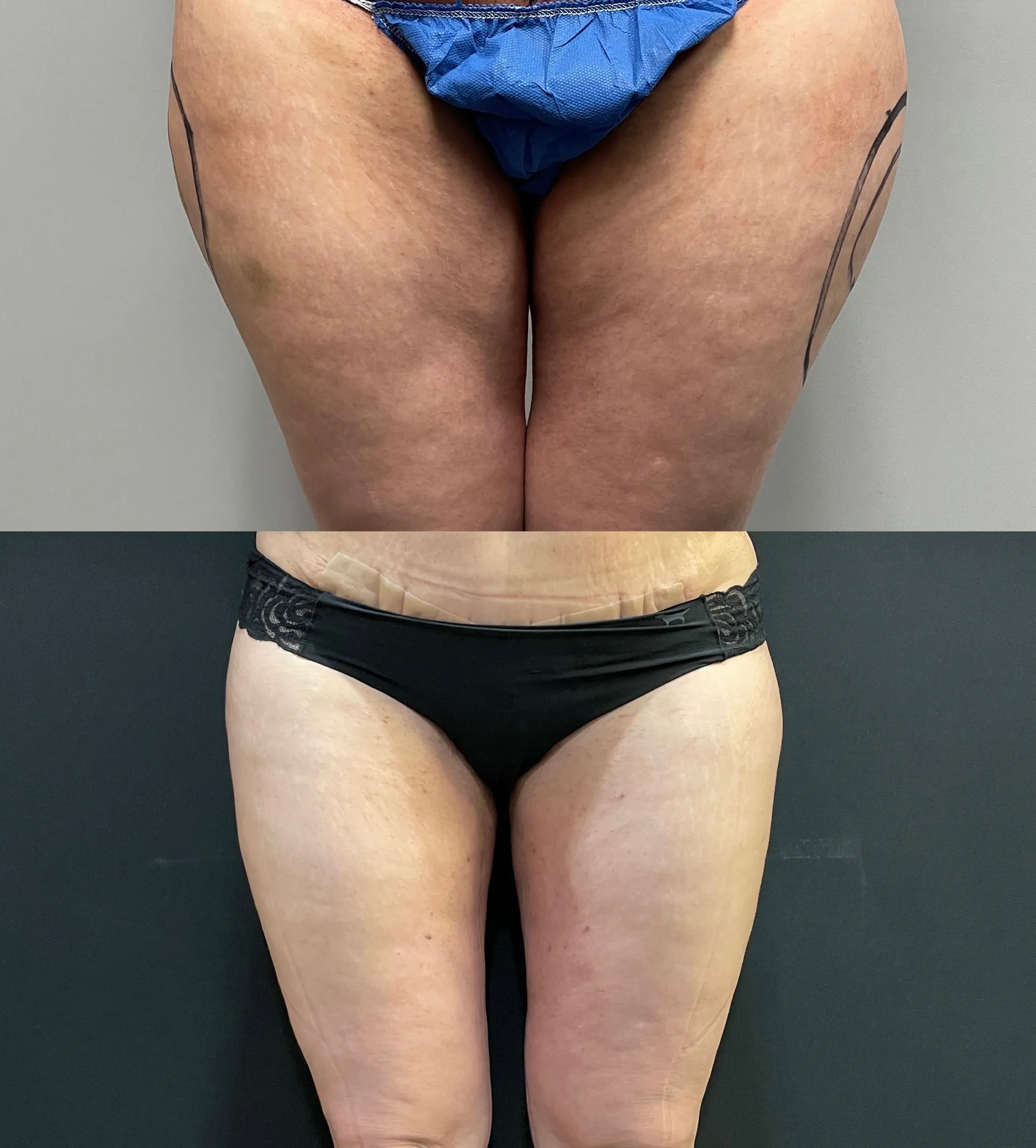 Thighs before & after — case 72