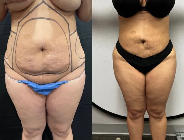 Mini Tummy Tuck before & after — case 53