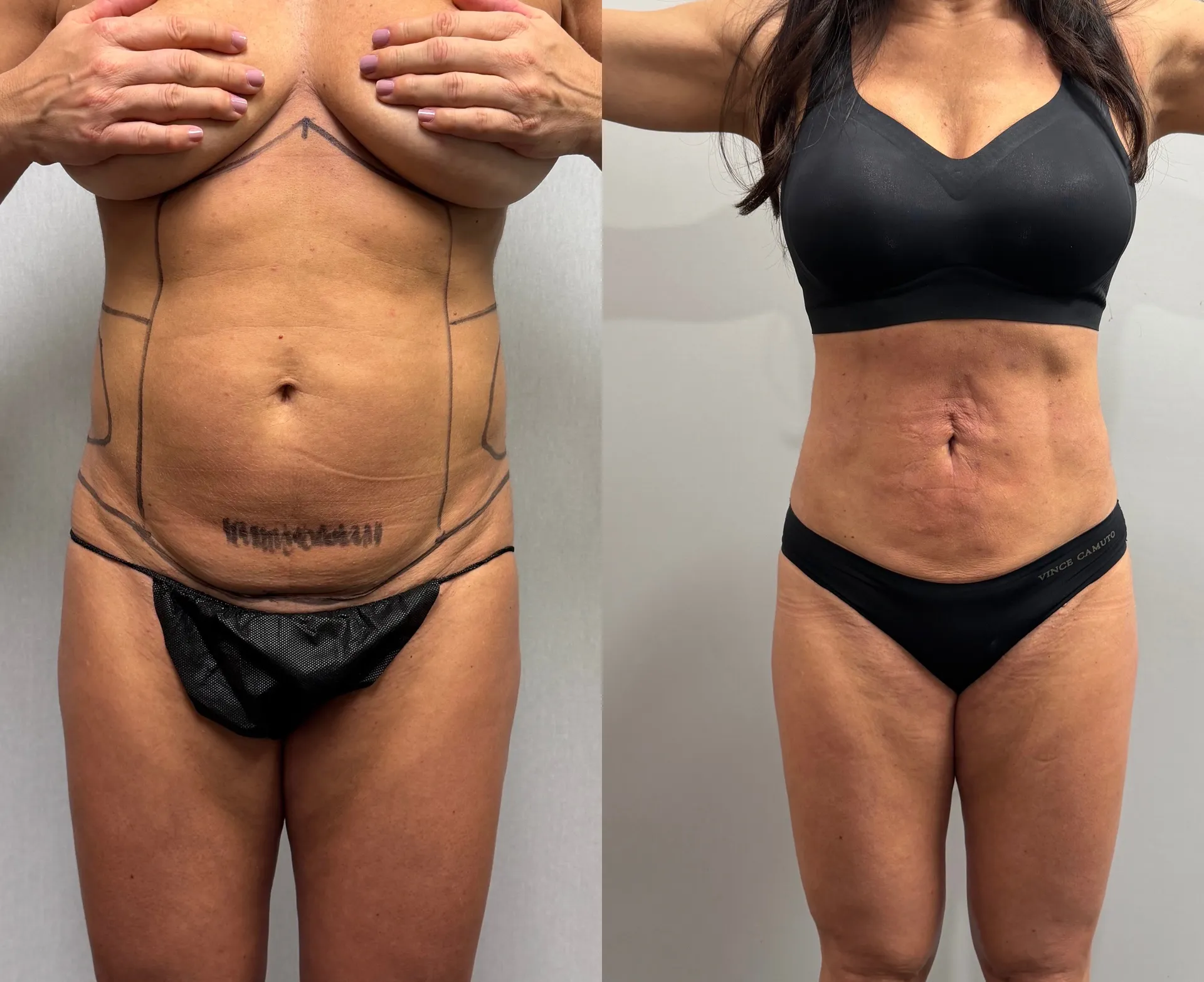 Abdomen before & after — case 23