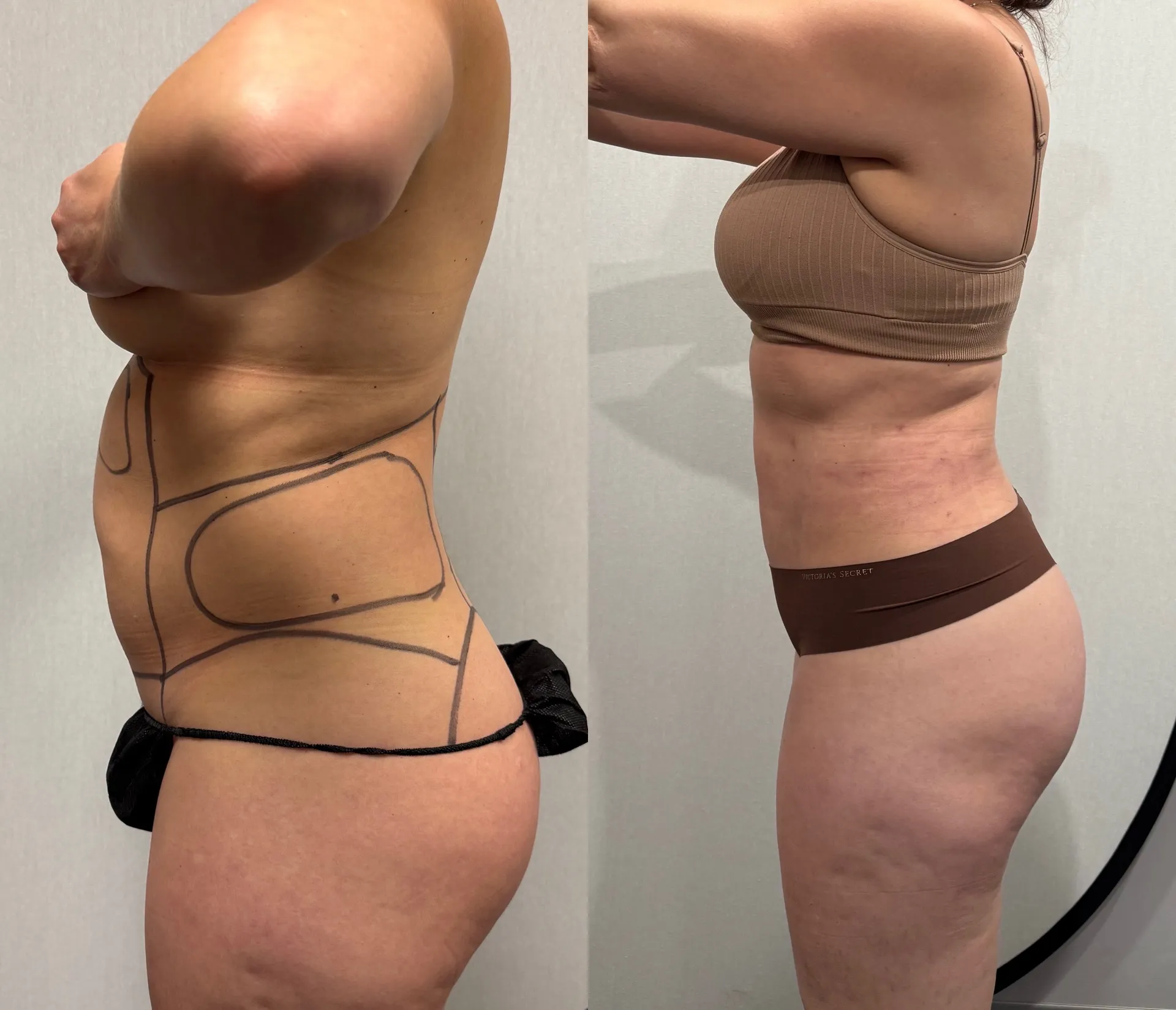 Sides & Flanks before & after — case 77