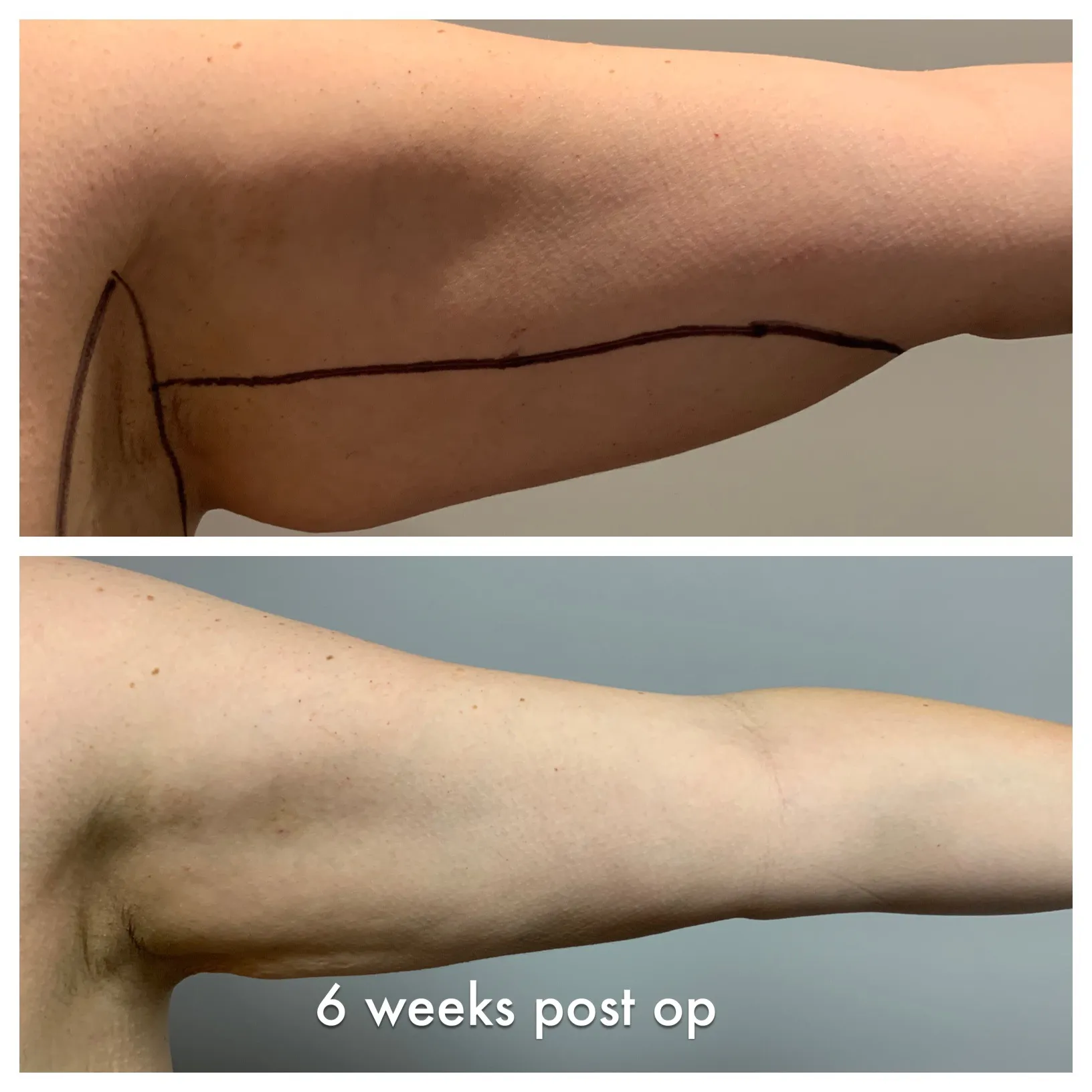 Arms before & after — case 05