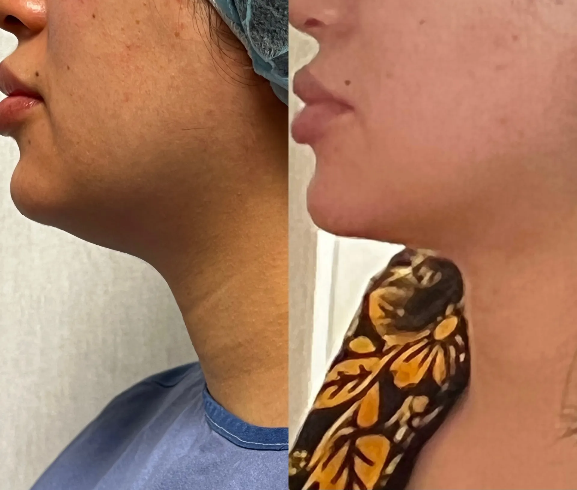 Chin & Neck before & after — case 65
