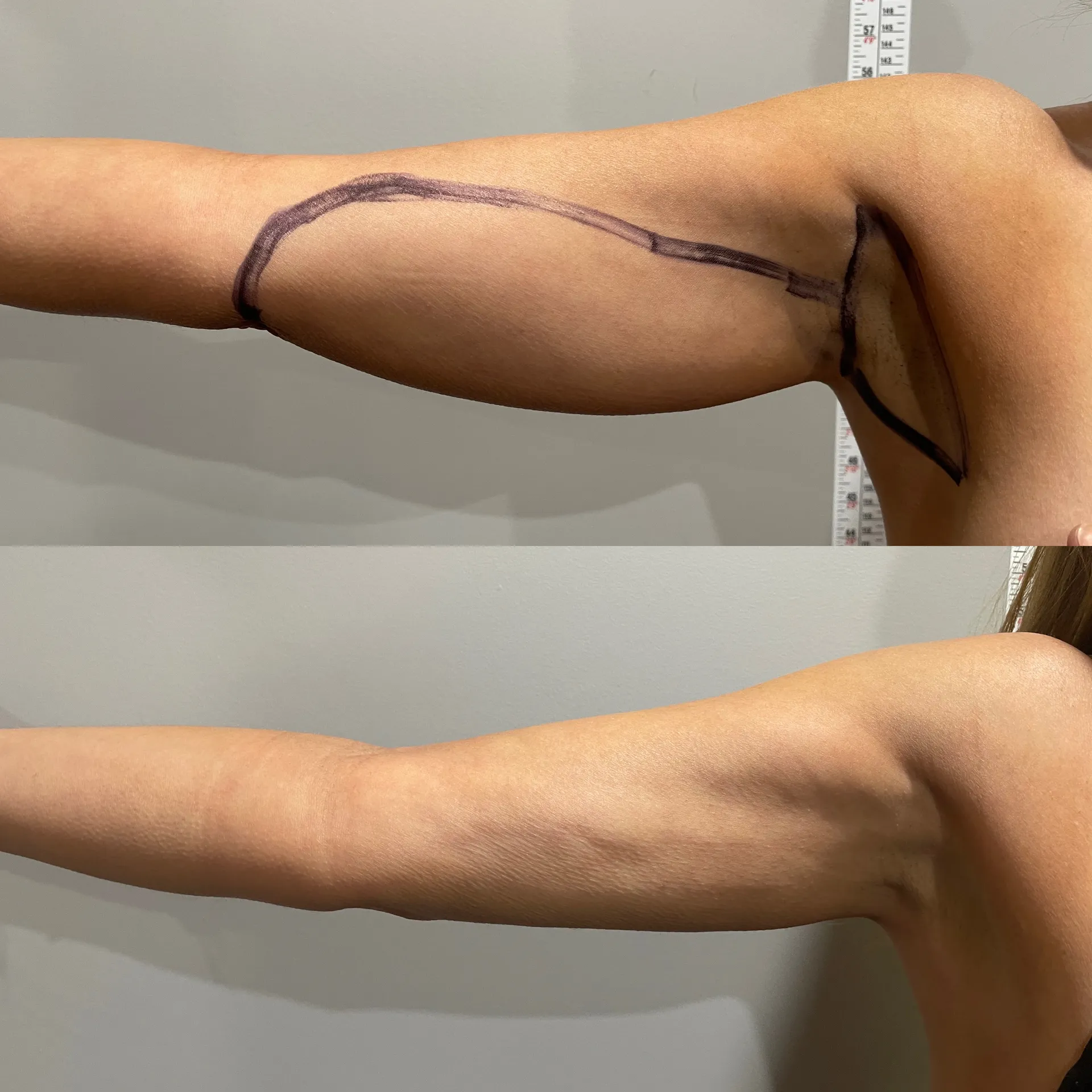 Arms before & after — case 04