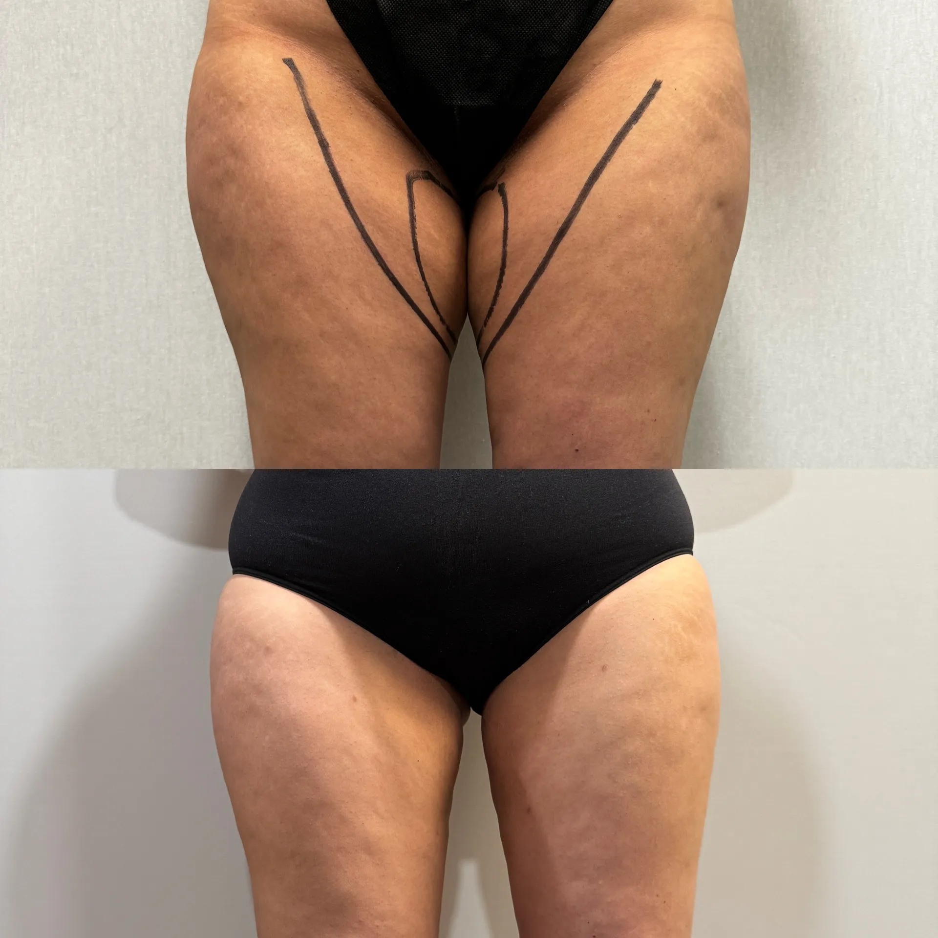 Results before & after — case 44