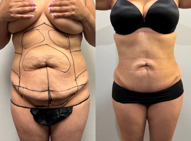 Mini Tummy Tuck before & after — case 57