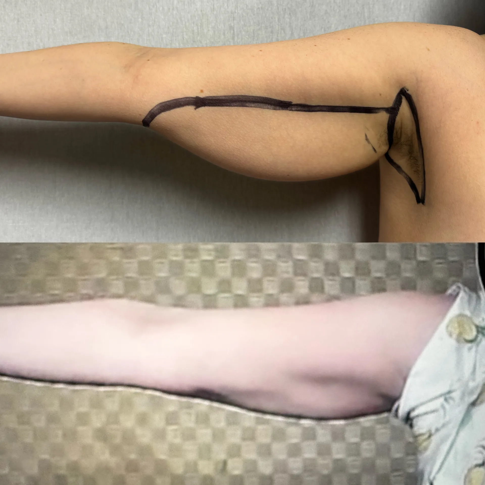 Arms before & after — case 01