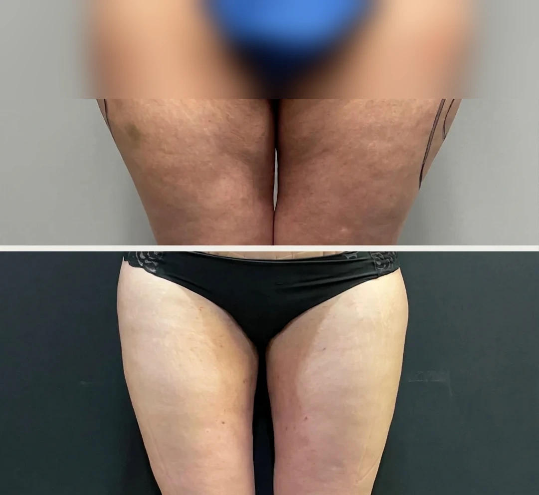 Women — Thighs