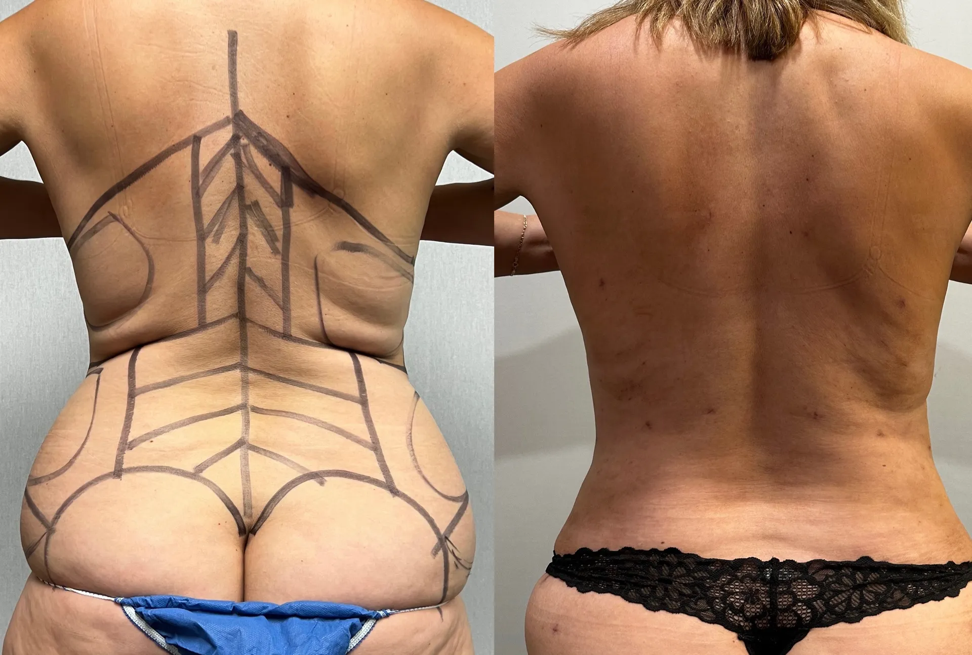 Back before & after — case 11