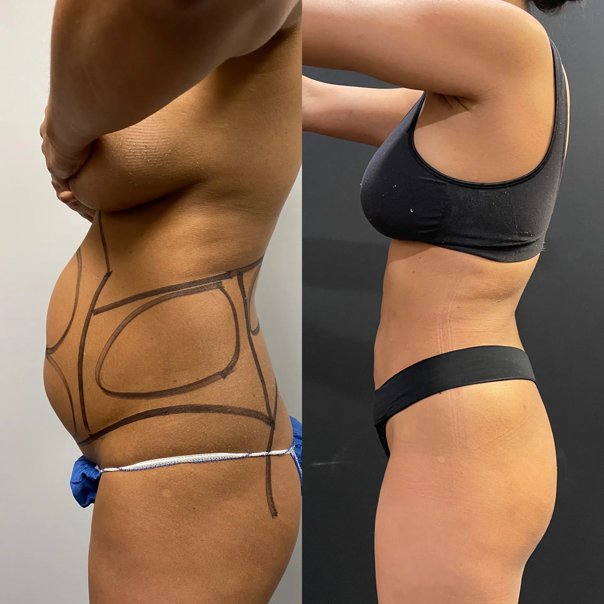 Sides & Flanks before & after — case 80