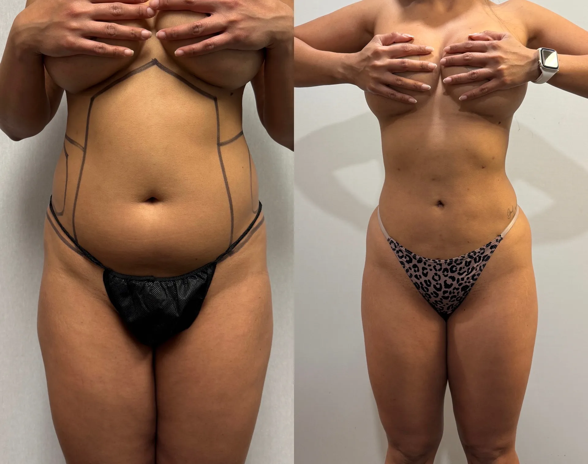 Abdomen before & after — case 30